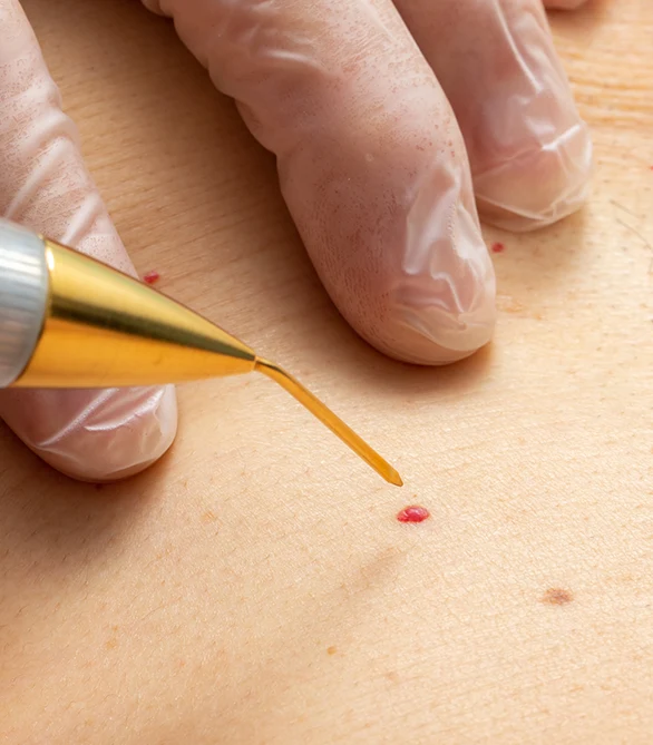 Advanced laser treatment for angiomas in Memphis, TN to improve skin clarity.