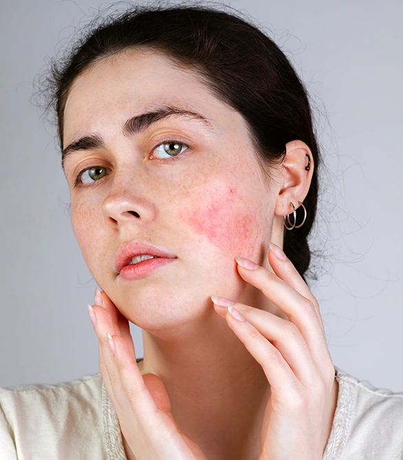 rosacea treatment in Memphis, TN for facial redness and visible blood vessels.