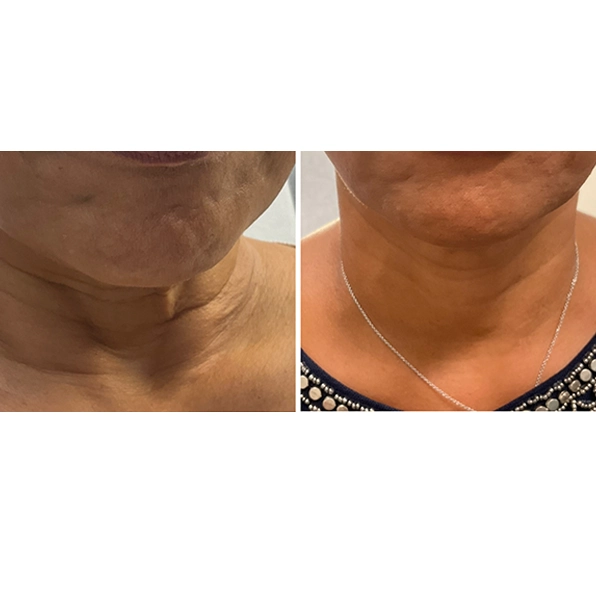 Before and After Gallery | Laser Skin Revitalization in Memphis, TN | Ivy Aesthetics and Laser Spa