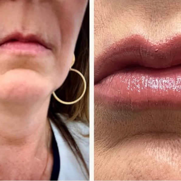 Before and After Gallery | Juvederm Lips Filler in Memphis, TN | Ivy Aesthetics and Laser Spa